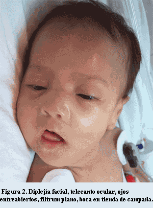 Sindrome De Steinert Neonatal Distrofia Miotonica Tipo 1 Congenita