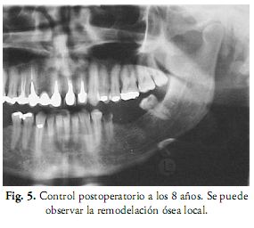 Osteoma de mandíbula: relato de caso