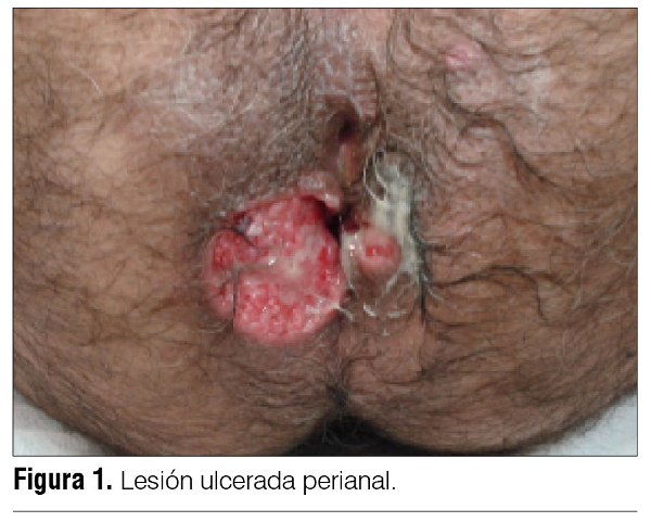 Sex Tuberculosis 15