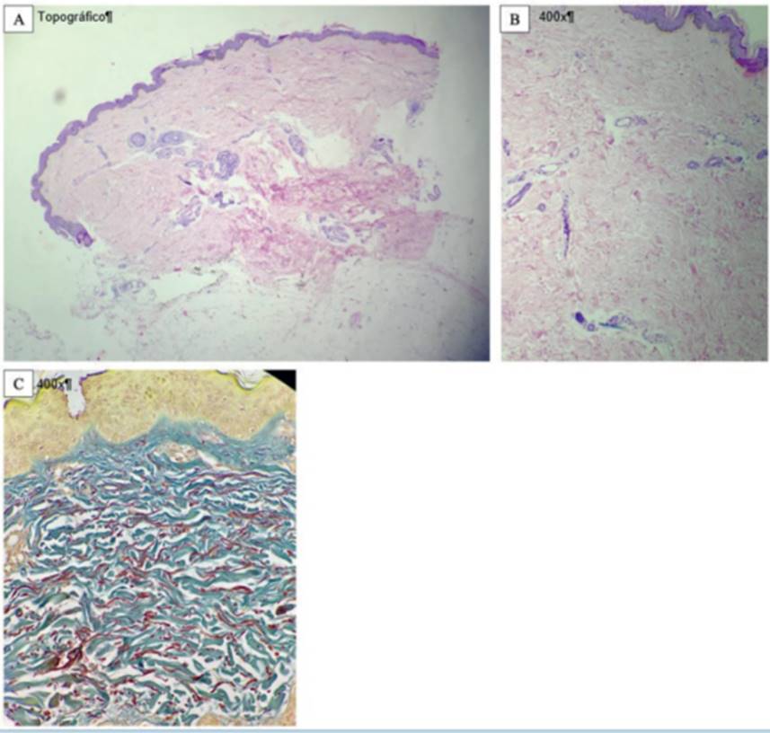 Atrofodermia de PasiniPierini, presentación de dos casos clínicos